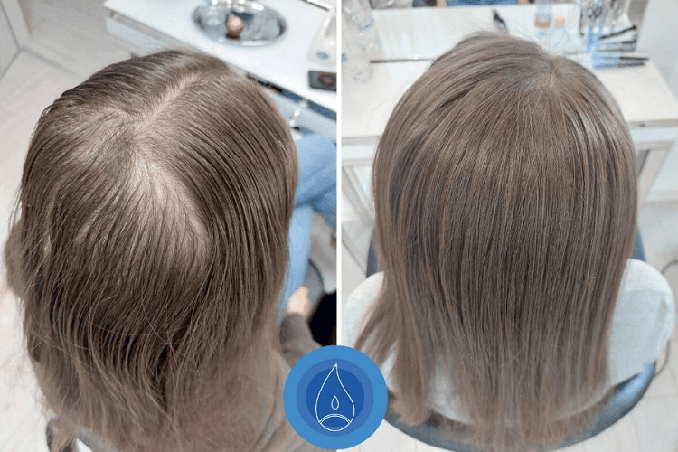 Clip-In vs Tape-In Extensions for Thinning Top Before and After